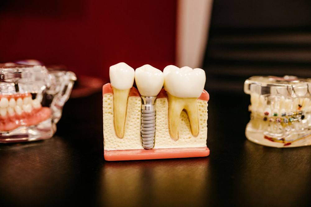 Modelo de implante dental con corona